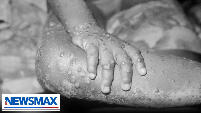 What is the mysterious 'Monkeypox' and how serious is it in America? | Dr. Richard McCormick