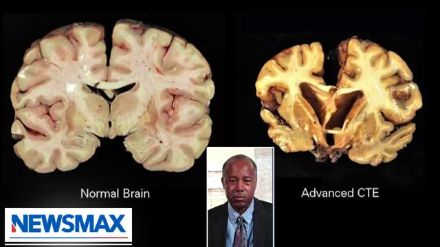 The brain is resilient, gives up after a while: Dr. Ben Carson | The Record with Greta Van Susteren